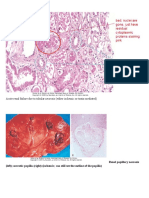 Acute Renal Failure Due To Tubular Necrosis (Either Ischemic or Toxin-Mediated)