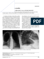 Sindrome de Lobulo Medio