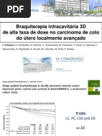 Braquiterapia intracavitária 3D de alta taxa de dose no carcinoma de colo do útero localmente avançado