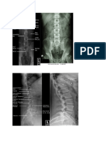 Lumb o Sacral