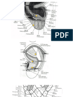 Paralisis Facial