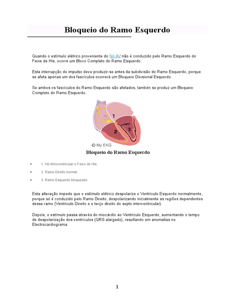 Bloqueio de Ramo Esquerdo Imp Eletrocardiografia Infarto do Miocárdio