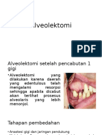 Alveolektomi