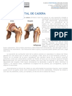 articulo protesis de cadera.pdf