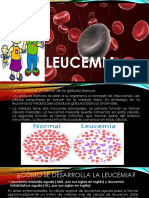 LEUCEMIA