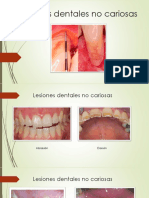 1 - Lesiones Dentales No Cariosas1