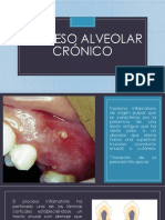 Absceso Alveolar Crónico