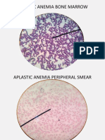 Aplastic Anemia Bone Marrow