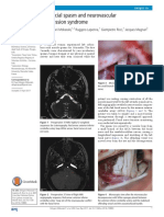 Hemifacial Spasm and Microvascular Compression Syndrome.full