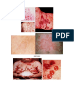 Tuberculosis Cutánea