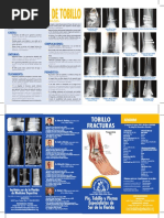 Proceso de Stieda y su tratamiento | PDF | Tobillo | Cirugía