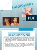 Hipertiroidismo 130429234907 Phpapp01