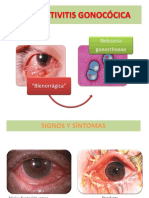 Conjuntivitis Gonocócica