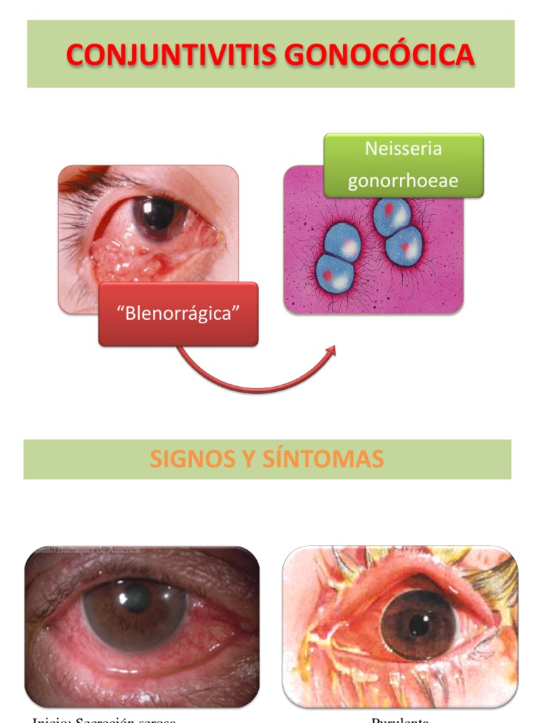 Conjuntivitis Gonocócica | PDF