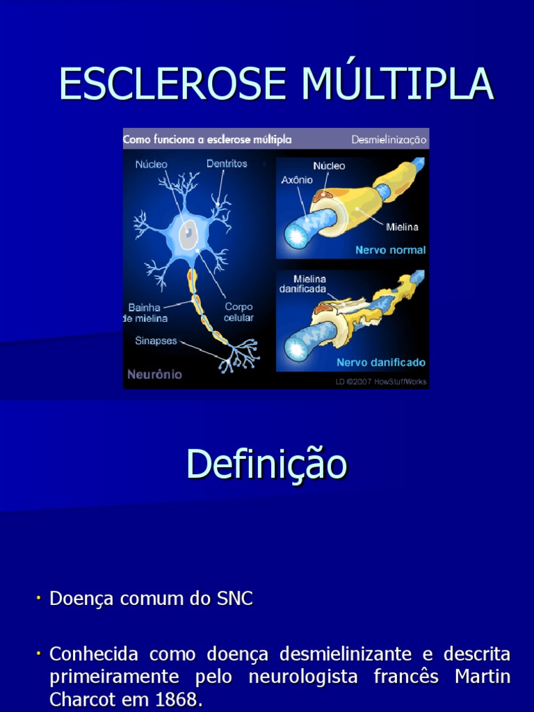 ESCLEROSE MÚLTIPLA.pdf | Esclerose Múltipla | Ciências da Saúde