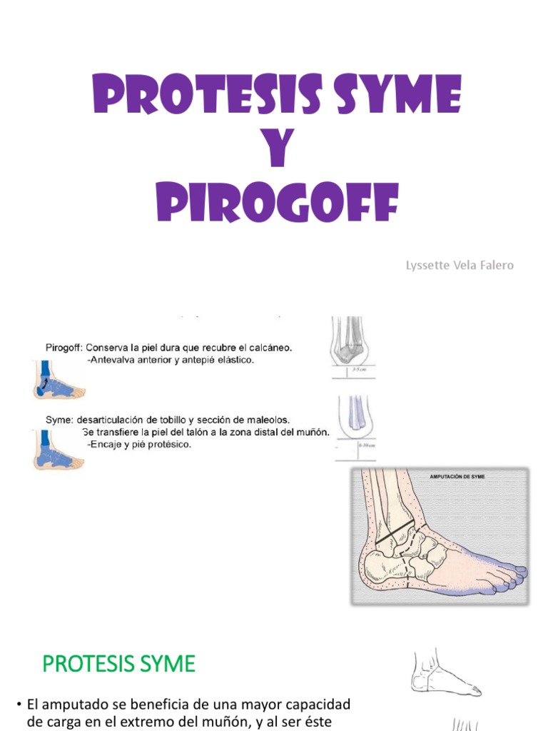 Protesis Syme y Pirogoff: Comparativa | PDF | Dentadura postiza | Science