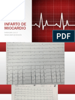 Infarto de Miocardio (2)