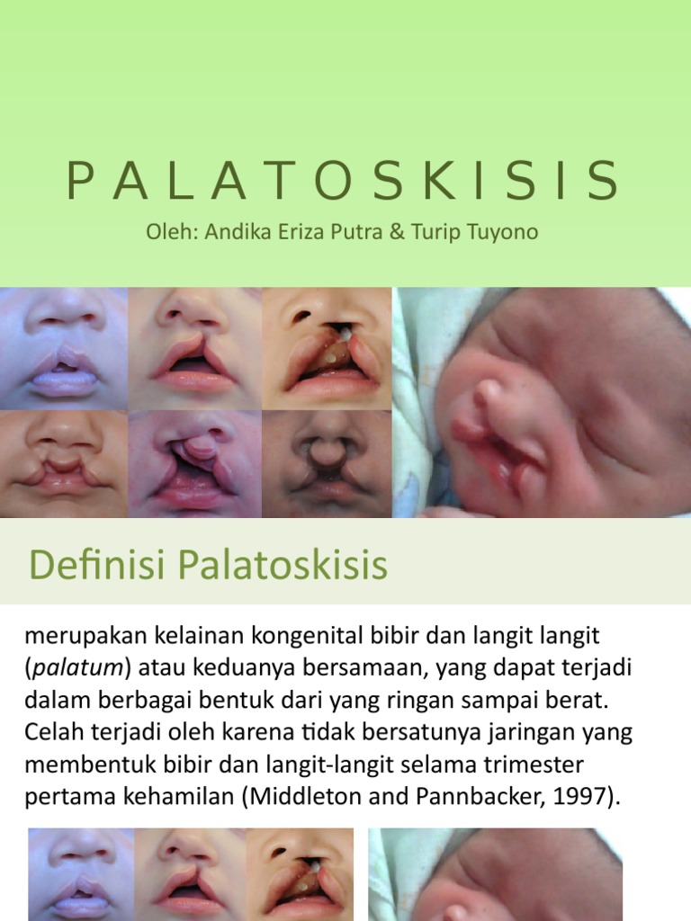 Manfaat dan Penanganan Palatoskisis | PDF