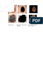 Original Image Segmentation Using K Means Clustering Tumour Extracted Using K Means Clustering