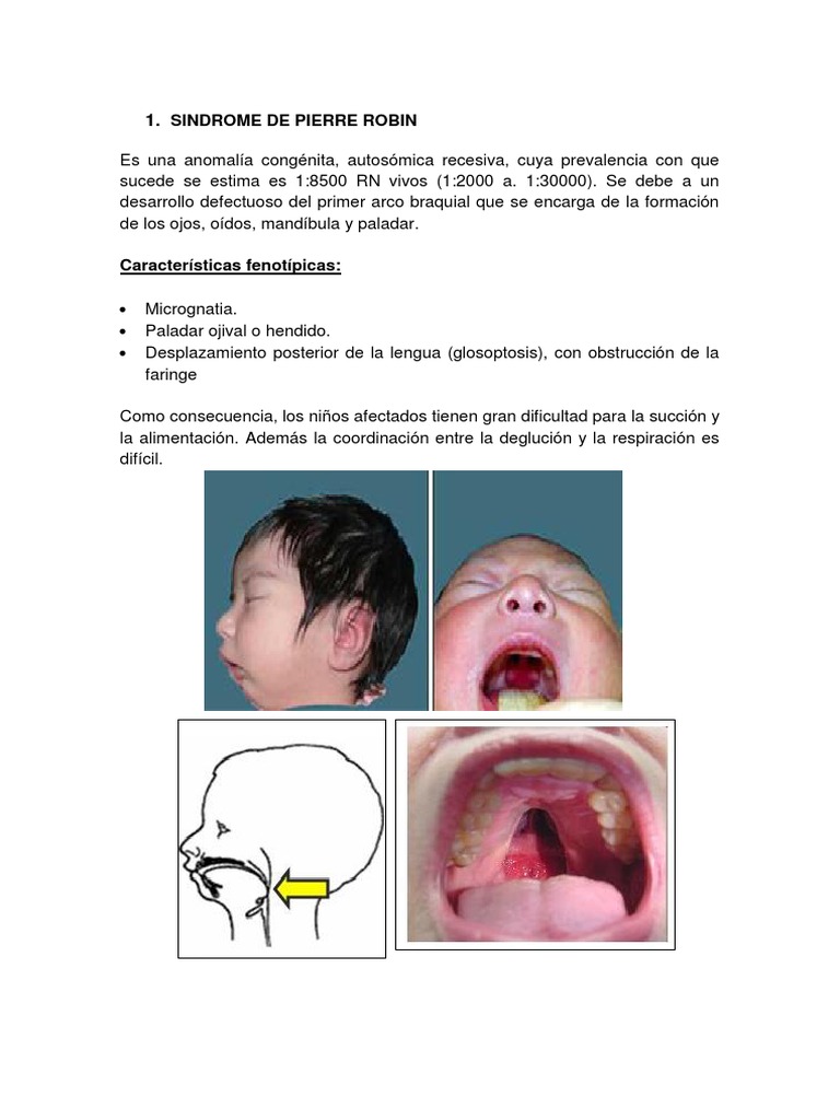 Características del Síndrome de Pierre Robin | PDF