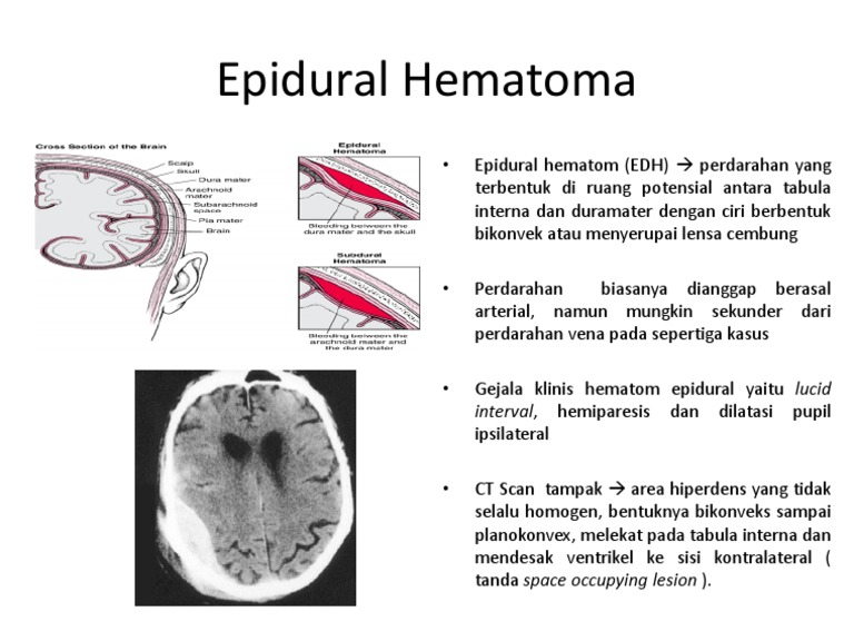 Epidural Hematoma