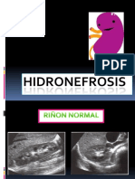 Alteraciones Renales en Ultrasonido