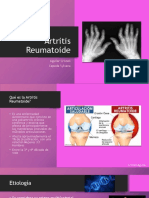 Artritis Reumatoide