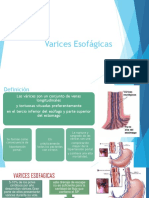 Varices Esofágicas