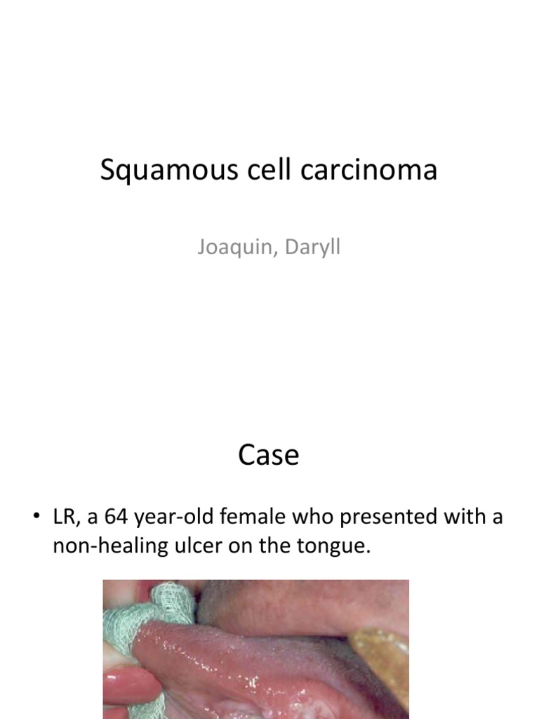 Tongue Squamous Cell Carcinoma Case Study | PDF | Metastasis | Head And ...