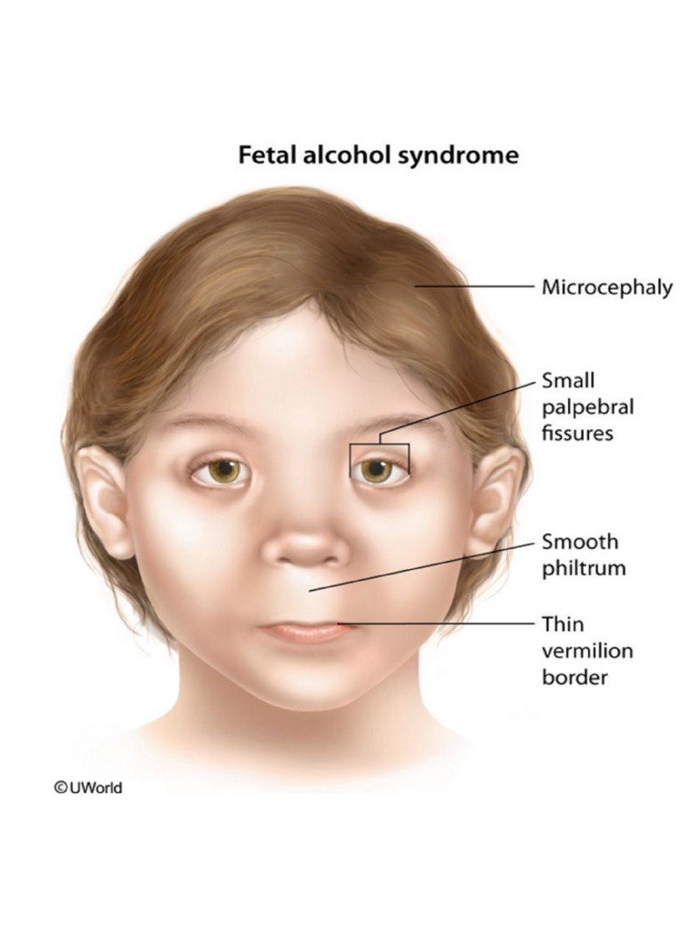 Adults With Fetal Alcohol Syndrome