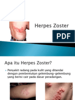 Herpes Zoster