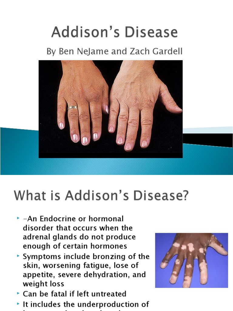 Addison's Disease: Symptoms and Effects | PDF | Adrenal Gland ...