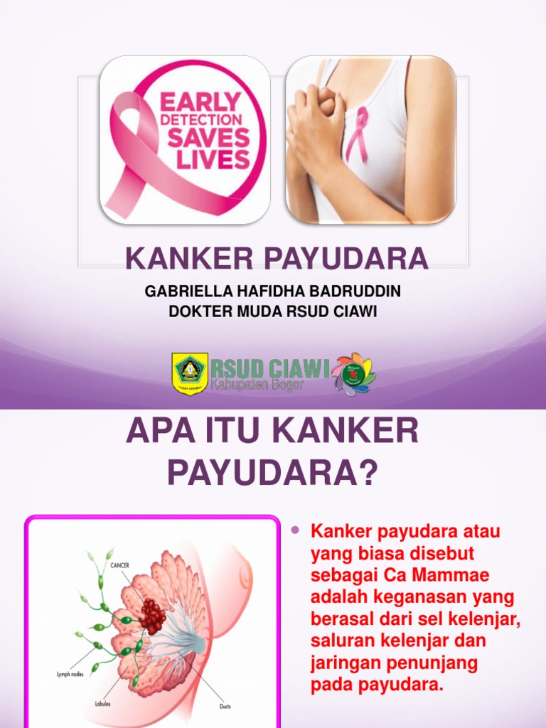 Ppt Penyuluhan Kanker Payudara Print 1