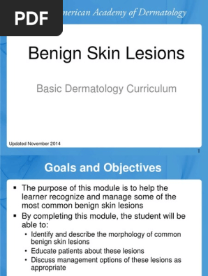 Benign Skin Lesions Basic Dermatology Curriculum - 