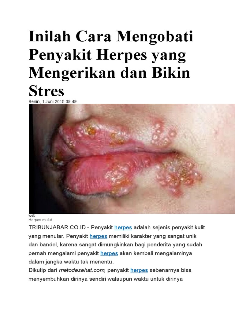 Cara Mengatasi Penyakit Herpes