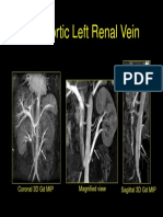 Retroaortic Renal Vein