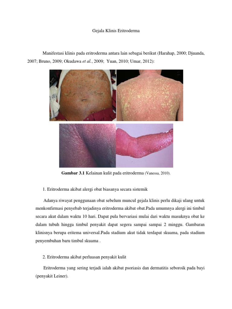 manifestasi klinis psoriasis