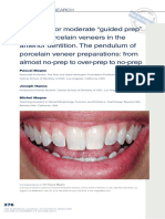 The Case For Moderate "Guided Prep" Indirect Porcelain Veneers in The Anterior Dentition. The Pendulum of Porcelain Veneer Preparations - From Almost No-Prep To Over-Prep To No-Prep