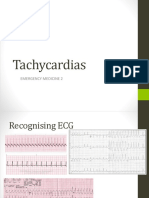 ACLS For Tachycardia