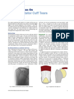 Focus On Rotator Cuff Tears