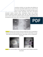 Foto Polos Sinar-X dan CT Scan untuk Diagnosa Spondilitis TB