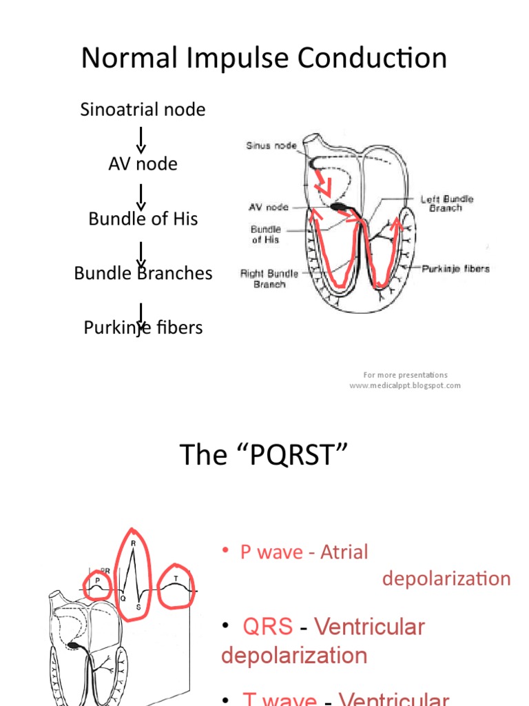 Normal Impulse Conduction Sinoatrial node AV node Bundle of His Bundle