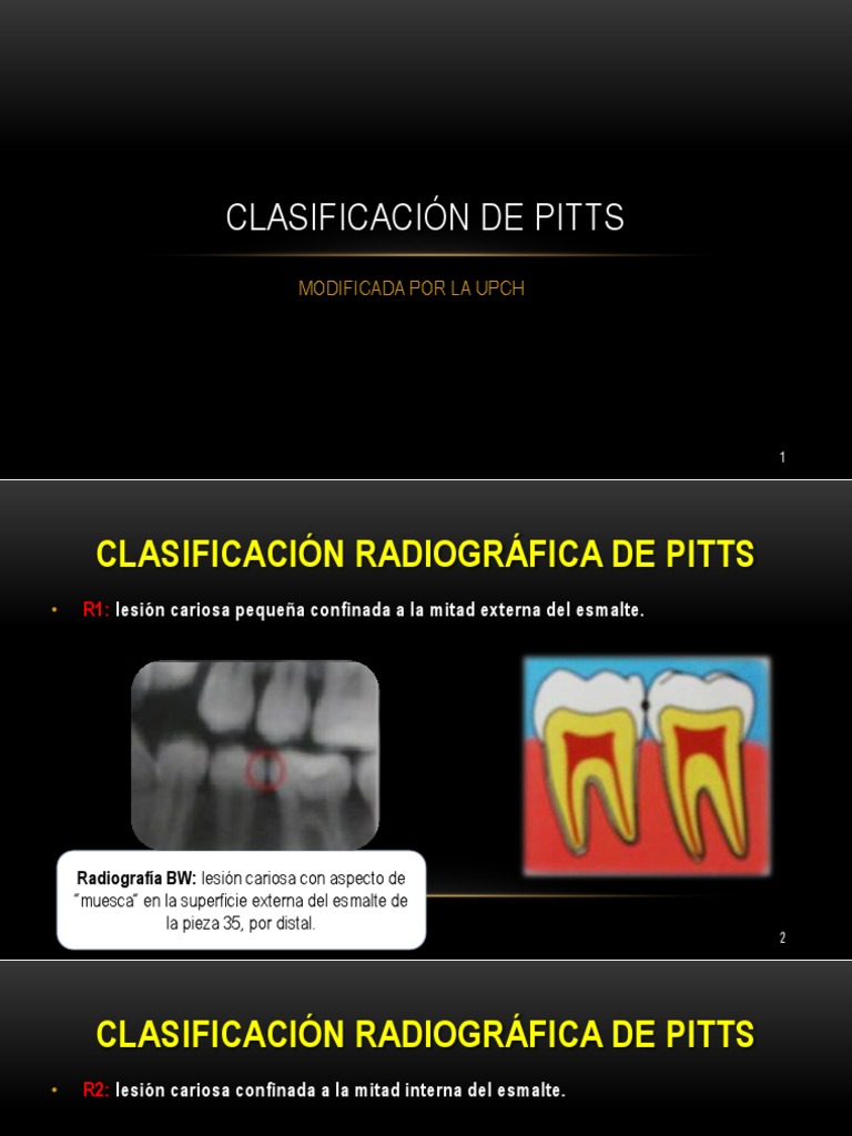 Clasificación Radiográfica de Caries de Pitts | PDF