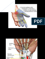 Neuroma de Morton