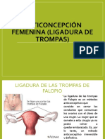 Anticoncepción Femenina (Ligadura de Trompas)-1