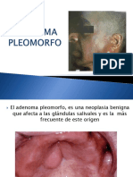 Adenoma Pleomorfo
