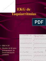 EKG Taquiarritmias