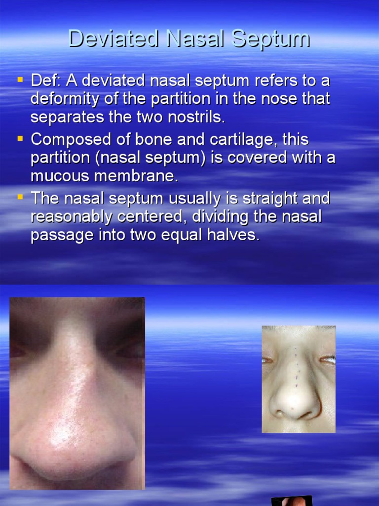 Deviated Nasal Septum