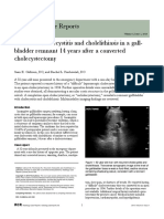 Recurrent Cholecystitis and Cholelithiasis in A Gall