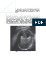 Paralisis cerebral infatil